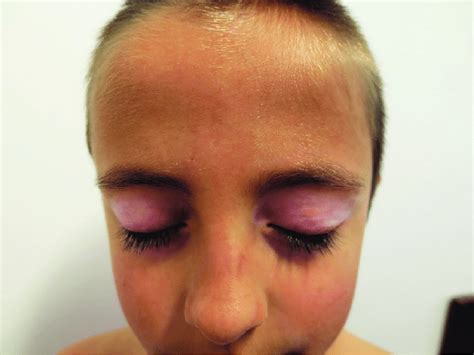 Hypopigmented Patches In The Upper Eyelids Periorbital Vitiligo