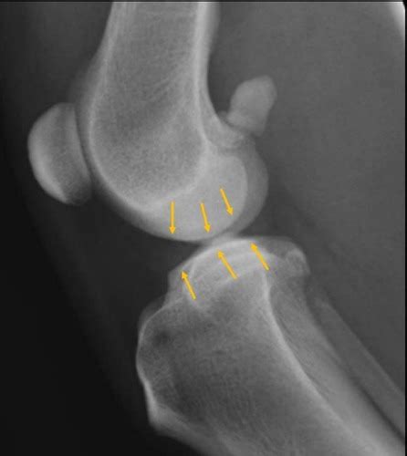 Radiographic Evaluation Of Joints Flashcards Quizlet