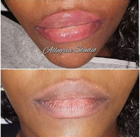 Lip Pigmentation Correction Allegria Studio Are Your Lips Uneven Do