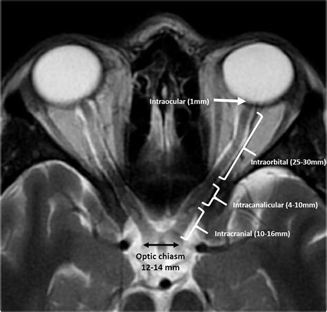 optic neuritis ms