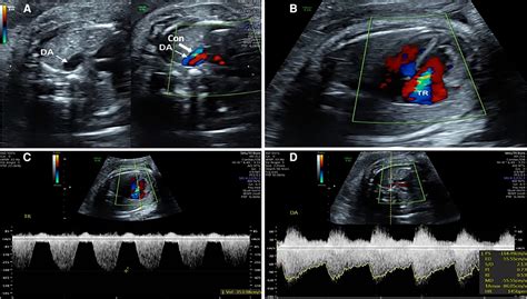 Frontiers Evaluation Of Changes Of Cardiac Morphology And Function In