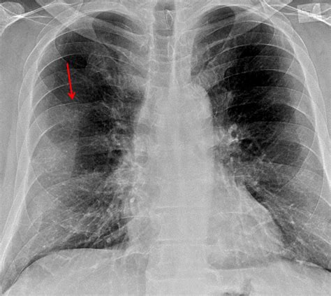 X Ray Broken Rib