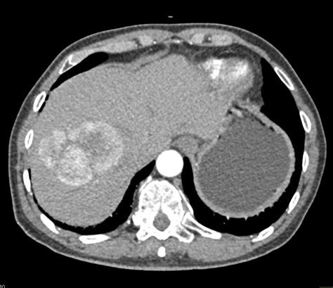 Hepatocellular Carcinoma Hepatoma With Pseudocapsule Liver Case