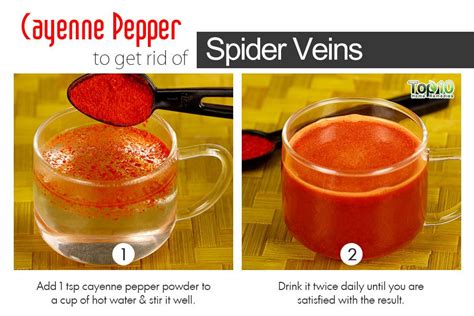 How to Get Rid of Spider Veins | Top 10 Home Remedies