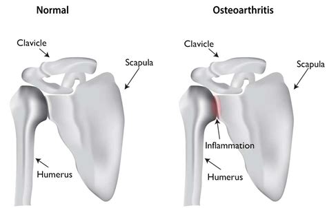 Shoulder Arthritis Orthopedic Shoulder Specialist Manhattan New