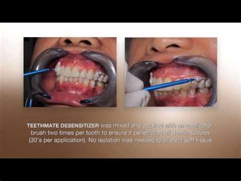 Desensitizing Procedure Using The NEW TEETHMATE DESENSITIZER From