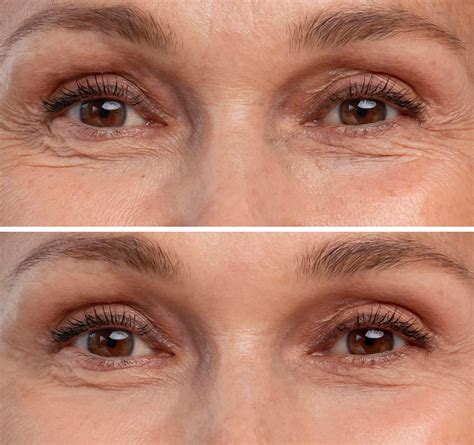 Blefaroplastia o que é preço como é feita e mais