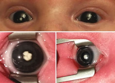 What Causes Congenital Cataracts In Cats Iruble