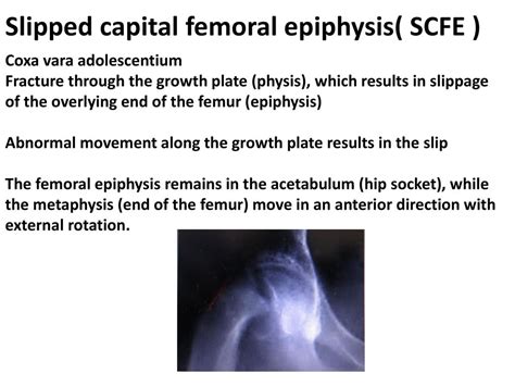 Slipped Capital Femoral Epiphysis Vs Legg Calve Perthes Disease