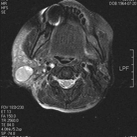 PDF Metastasis Of Nasopharyngeal Carcinoma To Parotid Lymph Nodes A