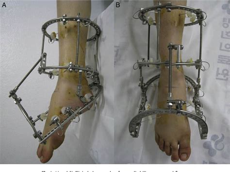 Figure From Use Of Ilizarov External Fixation Without Soft Tissue