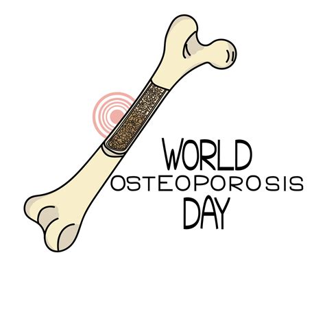 World Osteoporosis Day Schematic Representation Of The Bone The Internal Structure Of The Bone