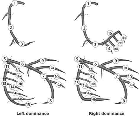 Impact Of Angiographic Complete Revascularization After Drug Eluting