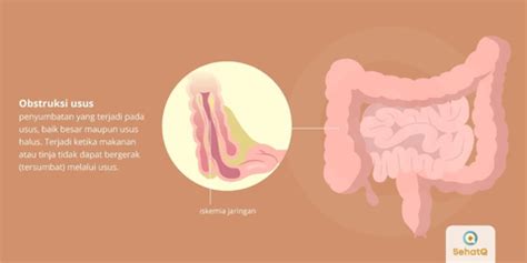 Ciri Ciri Penyumbatan Usus Pada Bayi Ini Cara Mengobati Usus Buntu