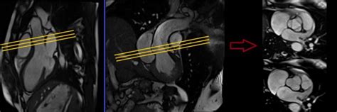 Cardiac Mri Protocols Planning And Techniques Positioning For