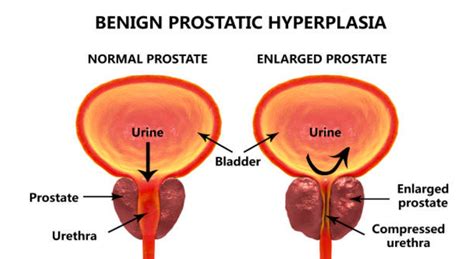 What You Should Know About Benign Prostatic Hyperplasia