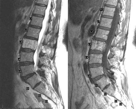 Spinal Hemangioma Pre Embo Mripng Mri Mri Scan Magnetic Resonance