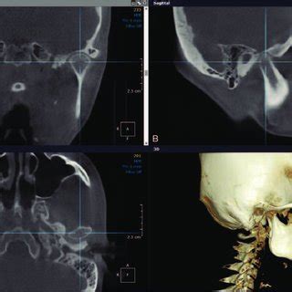 Ac Preoperative Facial Images Showed A Well Positioned Maxilla And