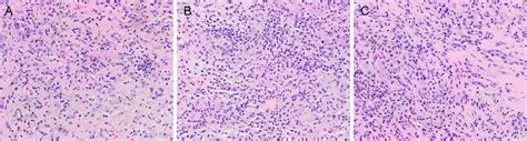 Pathological Findings Show Fibrous Stroma With Mixed Inflammatory Cell