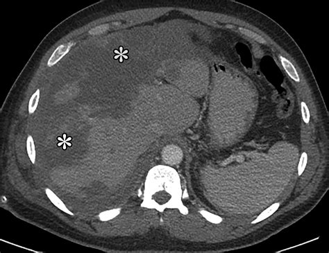 Manifestations Of Sickle Cell Disorder At Abdominal And Pelvic Imaging