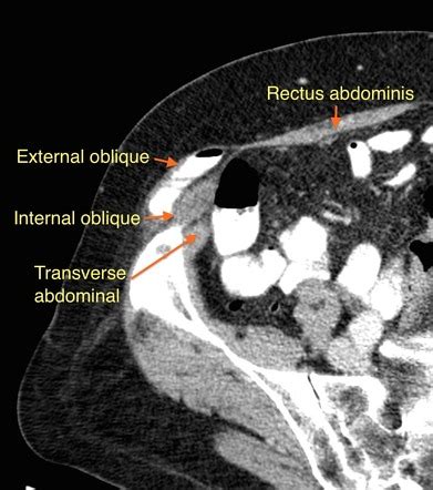 Spigelian Hernia Radiology Reference Article Radiopaedia Org