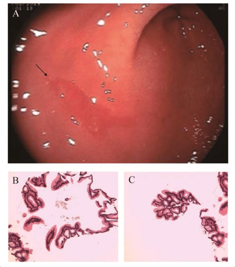 A Electronic Gastroscopy Bc Gastric Antrum Pathology Download Scientific Diagram