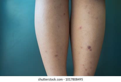 Categoría Dark spots on legs de imágenes fotos de stock e