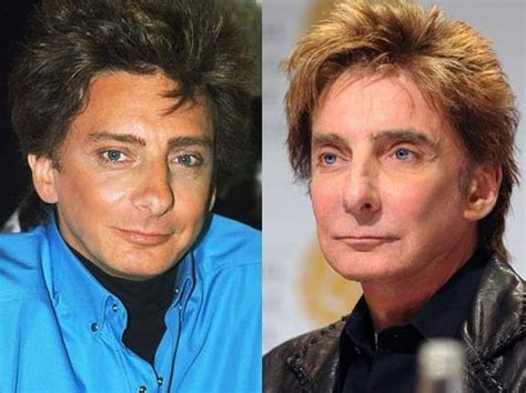 Barry Manilow Before And After Plastic Surgery 5 Celebrity Plastic