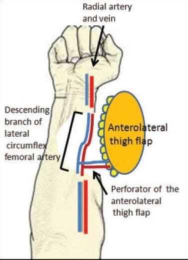 Emergent Free Flow Through Anterolateral Thigh Flaps For Gustilo