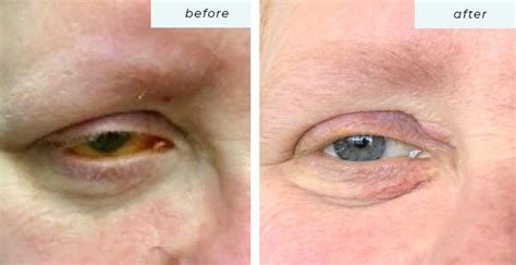 Ipl Treatments For Dry Eye And Skin Evening Greater Boston Optometry