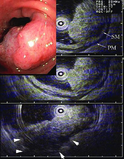 Wli Colonoscopy Firm Sigmoid Polyp Highly Suspicious For Malignancy