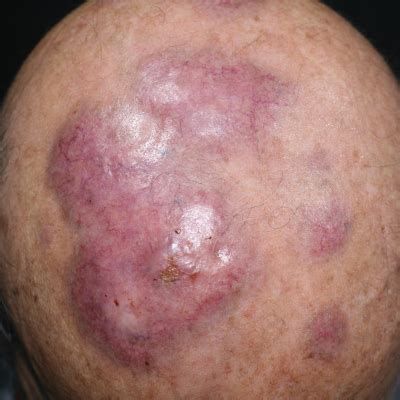 Asymptomatic Erythematous Plaques On The Scalp And Face MDedge