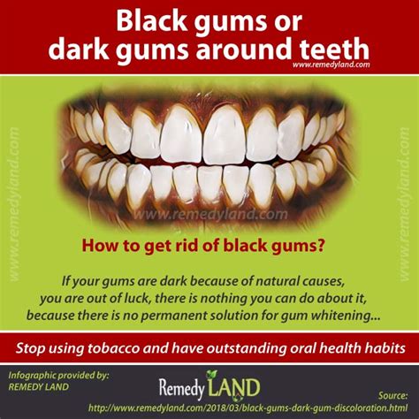 Black Gums Or Dark Gums Around Teeth Gum Discoloration Remedy Land