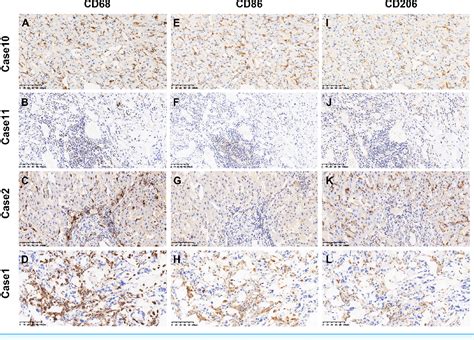 Figure From Cd Cd Tumor Associated Macrophages Predict