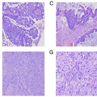 Immunohistochemical Findings Of Bilateral Ovarian Malignant Brenner