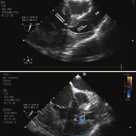 Two Dimensional Transesophageal Echocardiography Mid Esophageal Right Download Scientific