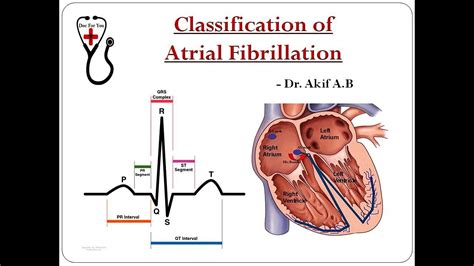 Classification Of Atrial Fibrillation Dr Akif Baig Youtube