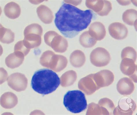 Sezary syndrome-Peripheral blood smear