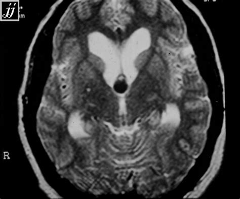 Brain – 3rd ventricle colloid cyst – Radioogle