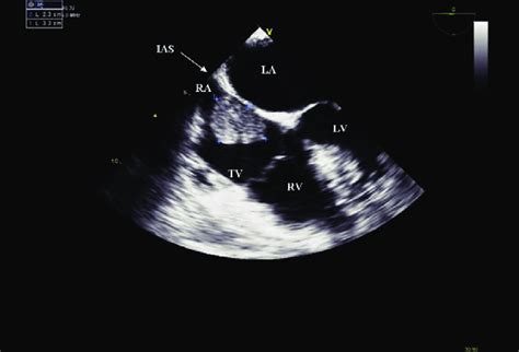 Transesophageal Echocardiogram Mid Esophageal 4 Chamber View