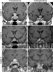 Spindle Cell Oncocytoma Of The Pituitary Gland In Journal Of