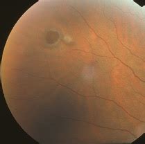 Retinal Tears And Holes Vitreoretinal Surgery Foundation