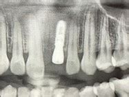 Level Certificate In Implant Dental Nursing Delta Dental