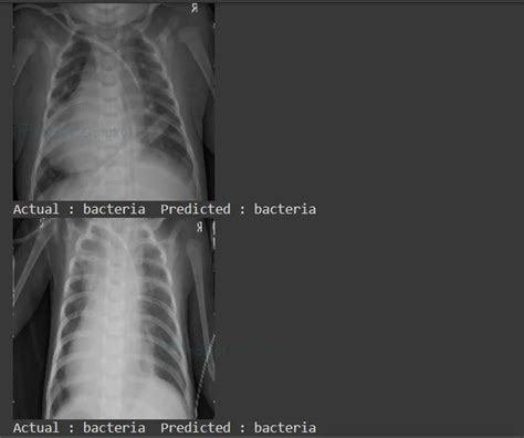 Pneumonia Detection Using Deep Learning Project Gurukul