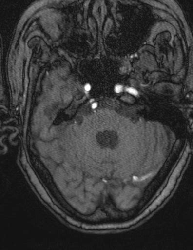 Choroid Plexus Xanthogranuloma Unilateral Radiopaedia