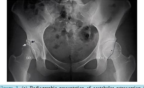 Figure 3 From Morphology Of Acetabulum And Femoral Head Neck Junction