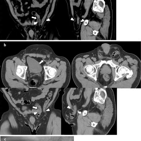 Diagnosis Of Inguinal Hernia By Prone Vs Supine Position Computed