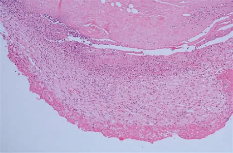 Figure 1 From Aortic Insufficiency Secondary To Enterococcus Faecalis