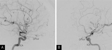 A B Postoperative Right A And Left B Internal Carotid Download Scientific Diagram