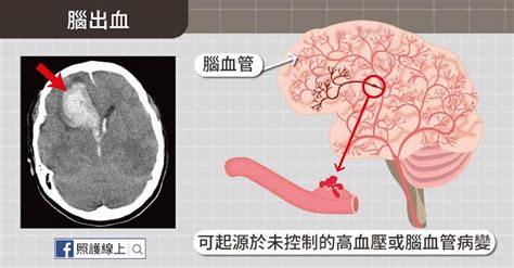 走路時頭撞到東西也有可能腦出血！醫師圖解 4 種顱內出血，每種都致命 照護線上 健康遠見